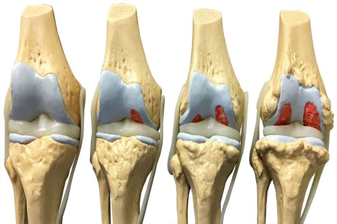 Stages of arthrosis development