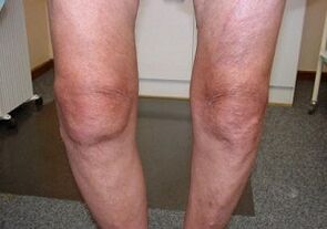 As you treated arthrosis of the knee joint