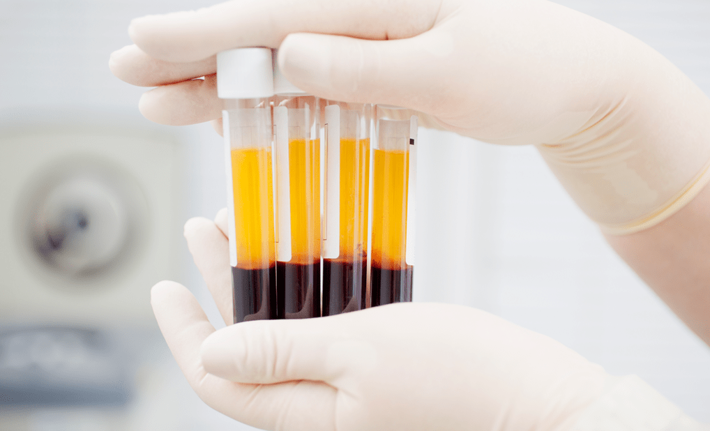 Plasma-rich plasma for PRP therapy for arthrosis