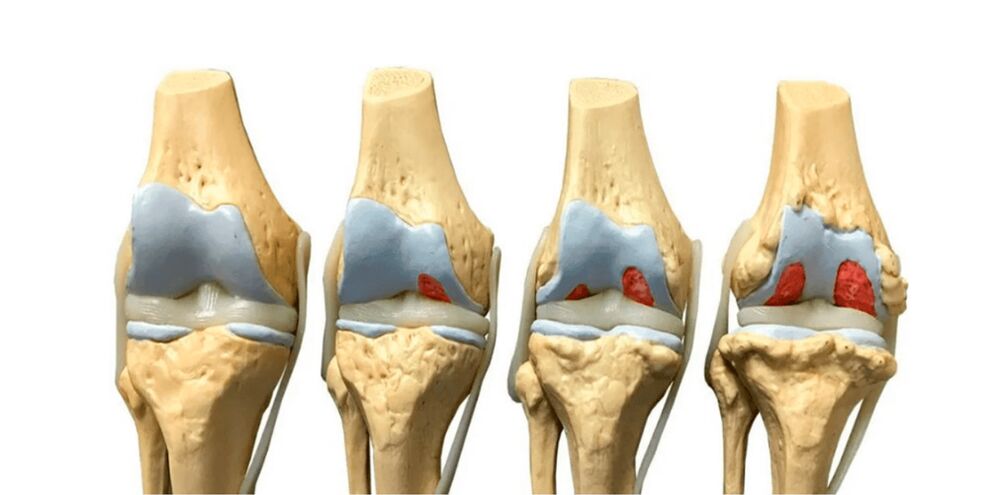 Degree of arthrosis of the joints